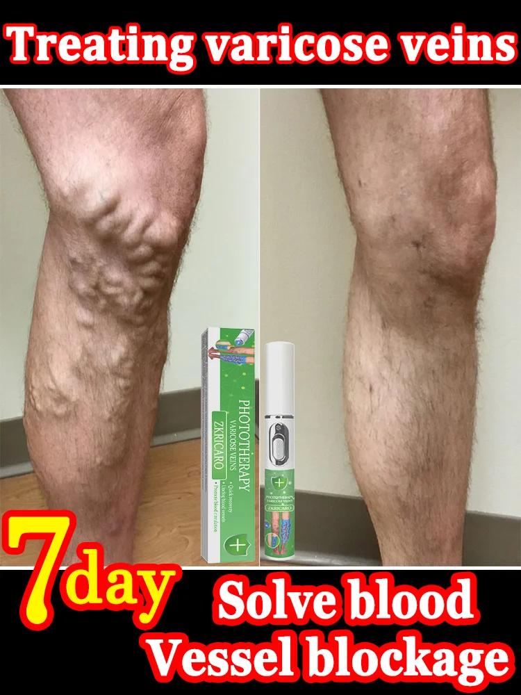 

Varicose vein laser pen