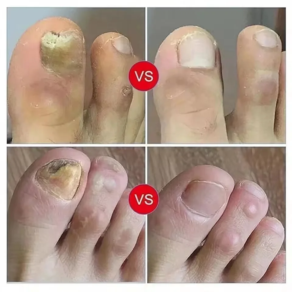 เล็บ Fungal Treatment Serum เท้าเชื้อราเล็บกําจัดน้ํามันหอมระเหย Anti Infection Onychomycosis Paronychia Repairing Care