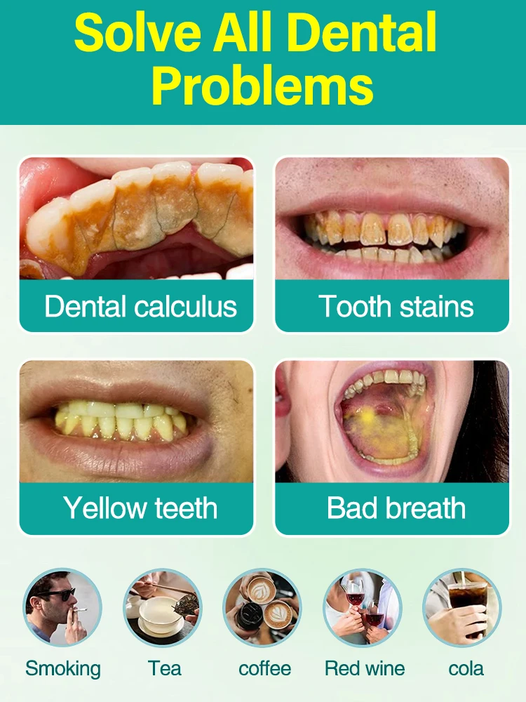 Removedor de cálculo dentário, branqueamento dos dentes, remoção do mau hálito, prevenção da periodontite, cuidados de limpeza dentária, mancha, hálito fresco, novo