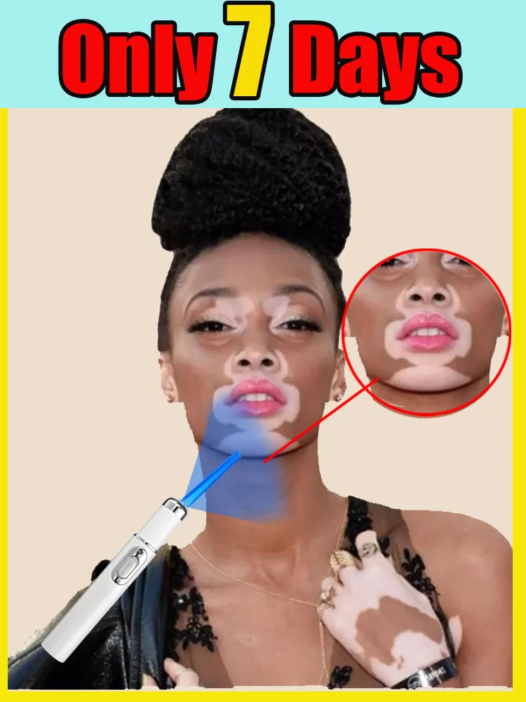 

Blue Light Pen home use remove white spots Provide comfortable experience, laser pointer care tools