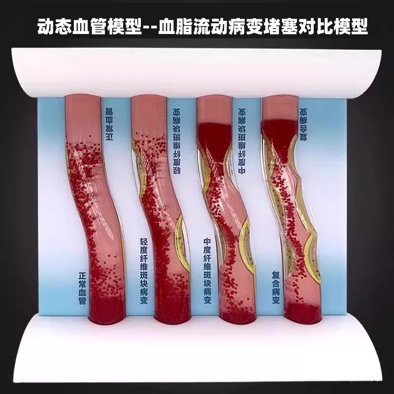 

Simulation of dynamic vascular lipid flow lesions versus complete blockage of arteriosclerosis