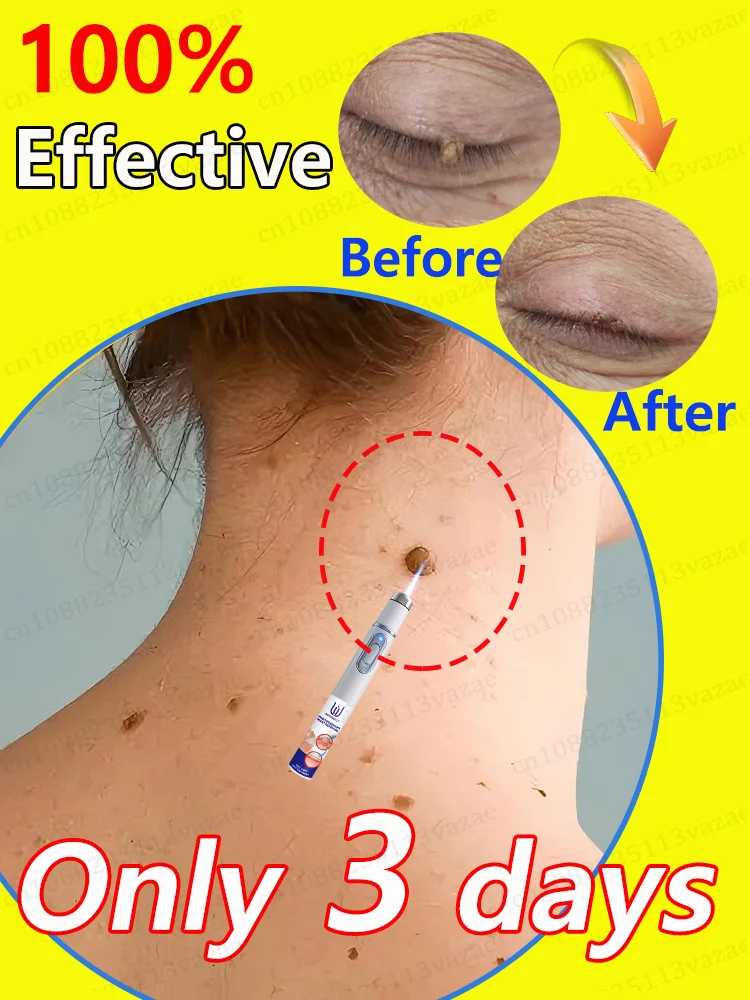 

Condyloma acuminatum zal niet langer naar jou komen