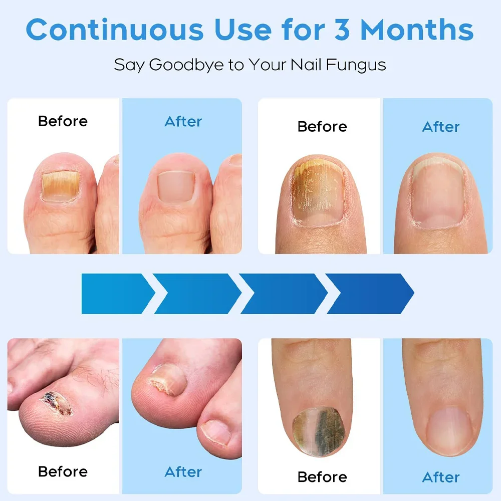 

At-Home Nail Fungus Laser Device, Fungal Nail Treatment Equipment, Effectively Remove Toenail Fungus Infection, USB Rechargeable