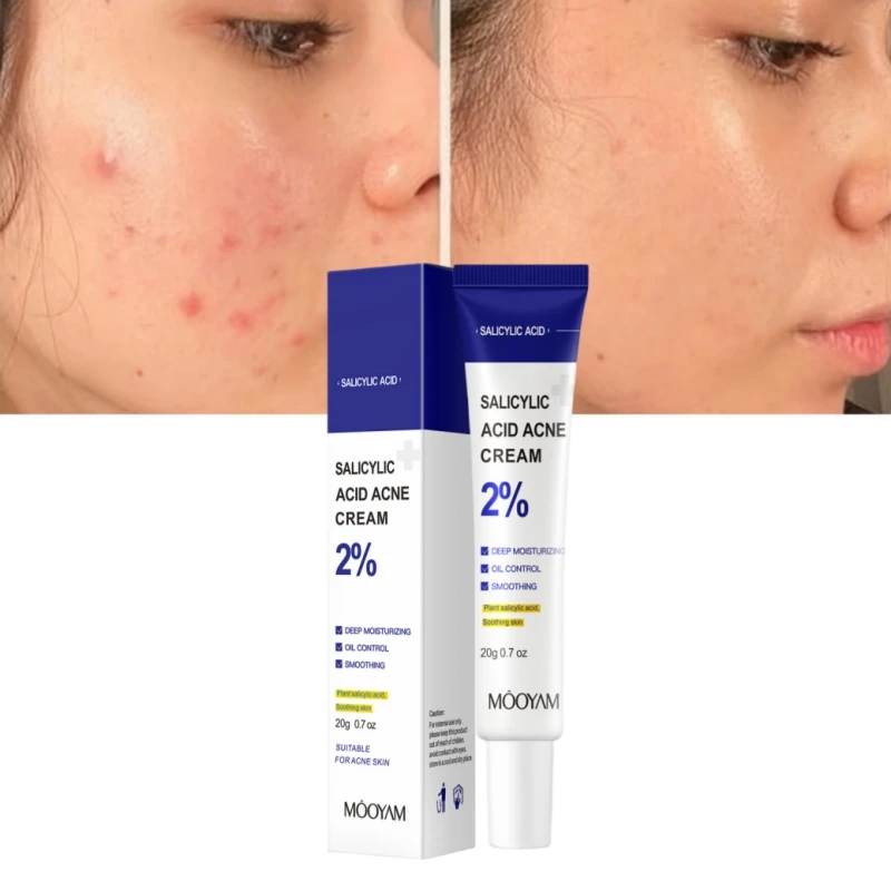 Salicylic Acid Acne Treatment Cream Remover Deep Scars Acne Prone Skin Repair Gel Oil Control Shrink Pore Blackhead Cleaner Care