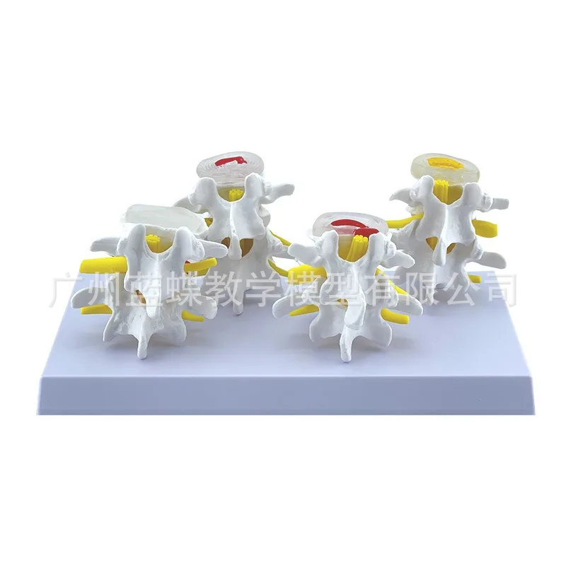 Skeleton Anatomical 4-stage Osteoporosis Vertebrae Anatomical Model Nursing Model Skin In Trauma Lumbar Degeneration Model