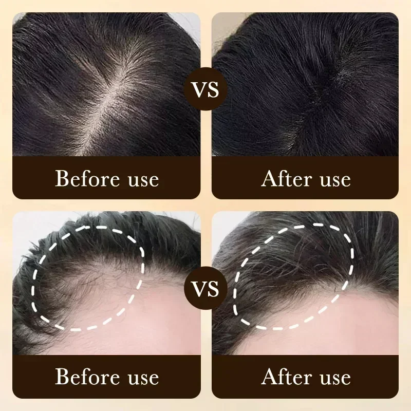 Sérum anti-calvitie efficace pour la croissance rapide des cheveux, réparation héréditaire post-partum, perte de cheveux séborrhéique, produits de beauté, expédition rapide