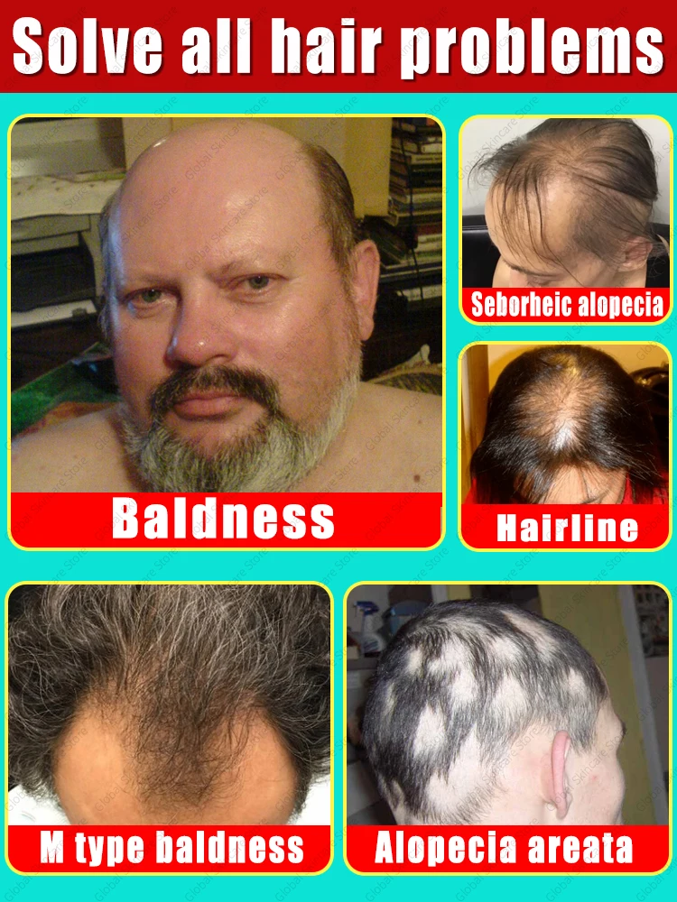 98% of customers repurchase, have more and more hair, say goodbye to baldness