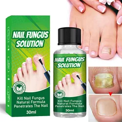 30ml Extra Strong Nail Fungus Treatment Serum Essence Oil Feet Nails Repair Care  Anti Infection Toe Fungal Removal Gifts