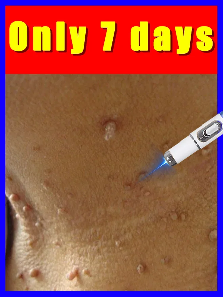 

wart care tools,Latest upgraded 2nd generation blue light pen solve warts,Free shipping,unisex,home use