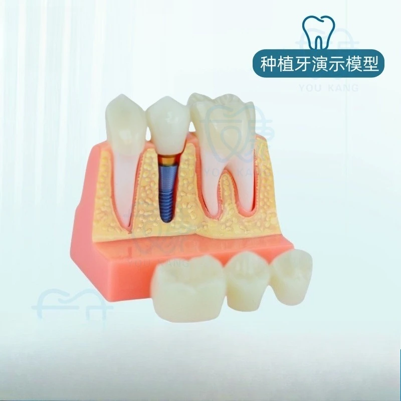 Dental Implant 4x Implant Solution Model, Denture Restoration Dental Implant Interpretation, Removable, Bridge Crown