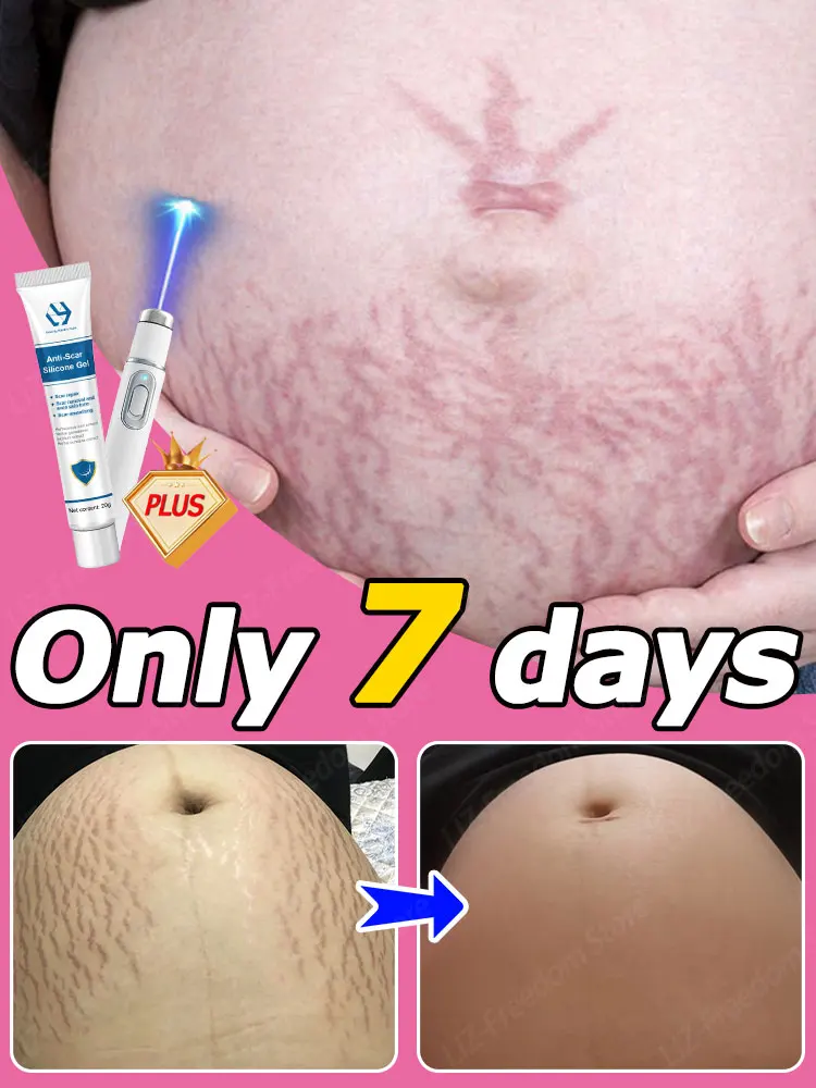 

Pregnancy Stretch Marks Eliminate Red White Old Surgical Cream