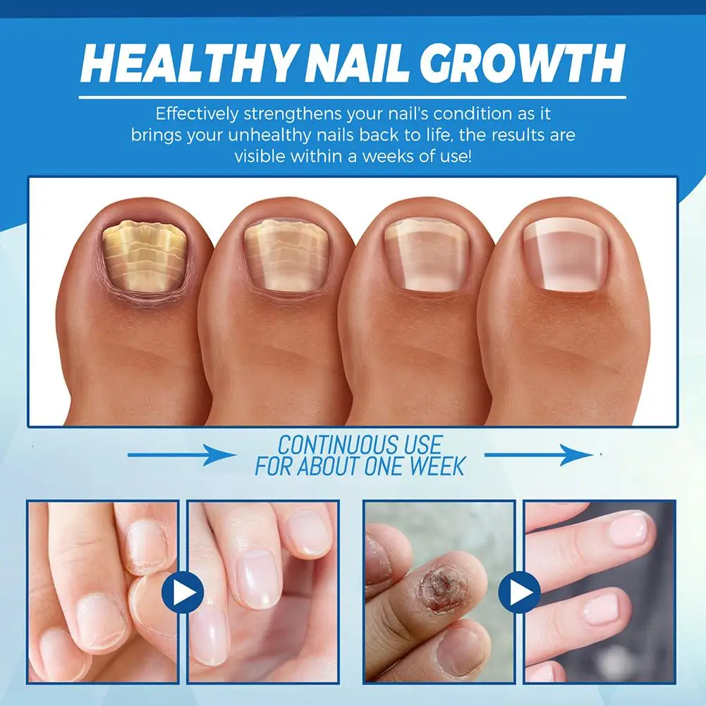 قلم علاج فطريات الأظافر قلم إصلاح مضاد للفطريات أداة القلم الأزرق الداحس مسمار فطار الأظافر إزالة الرعاية بالليزر Li B3U8