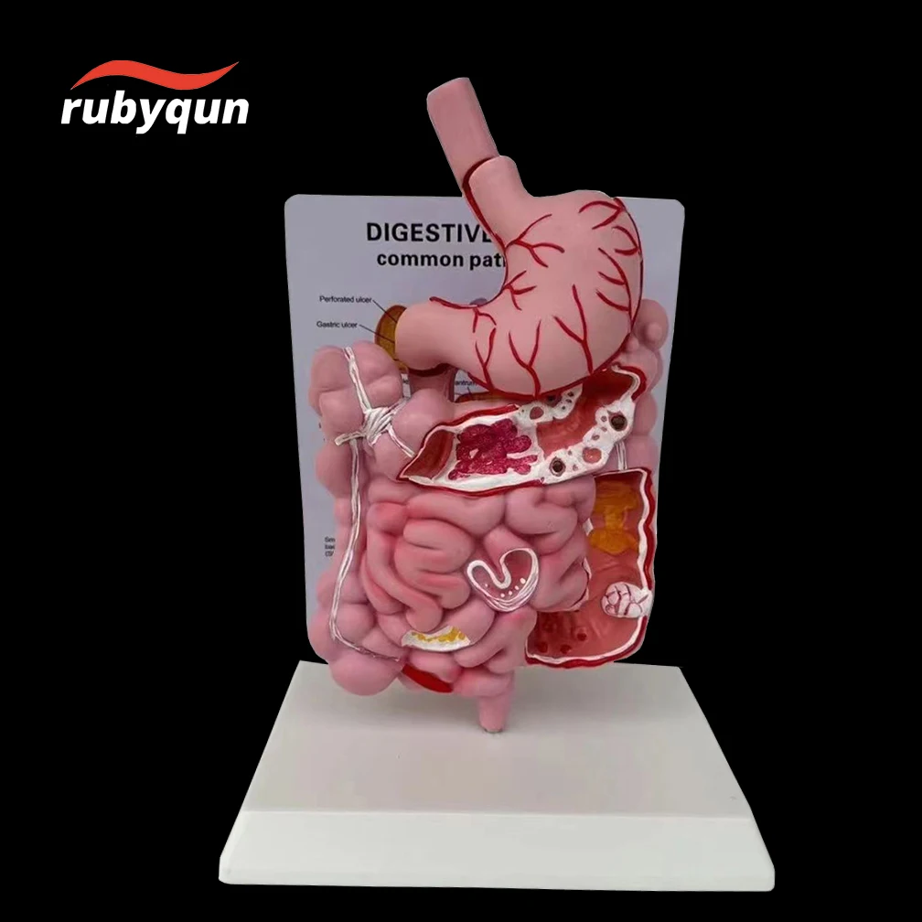 Human Large Intestine Pathological Model Gastrointestinal Anatomical Models Cecum Rectum Duodenum Science Medical Supply New