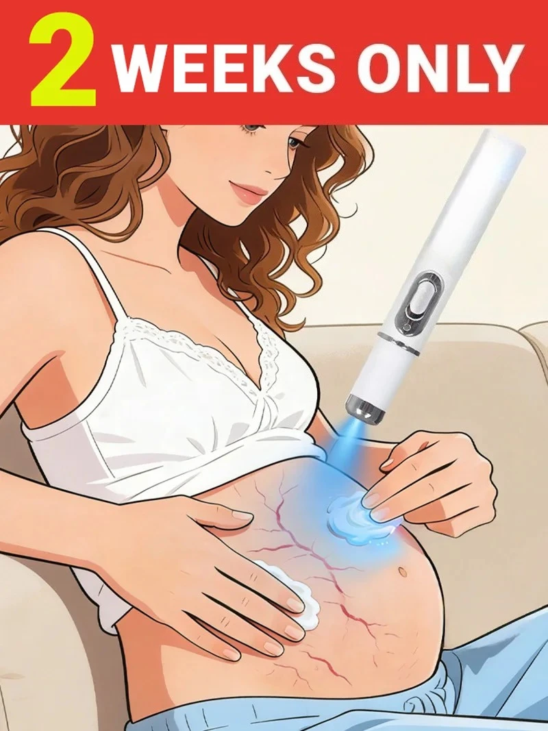 

Striae Blue Light Device Eliminate Body Stretch Marks Products Tools