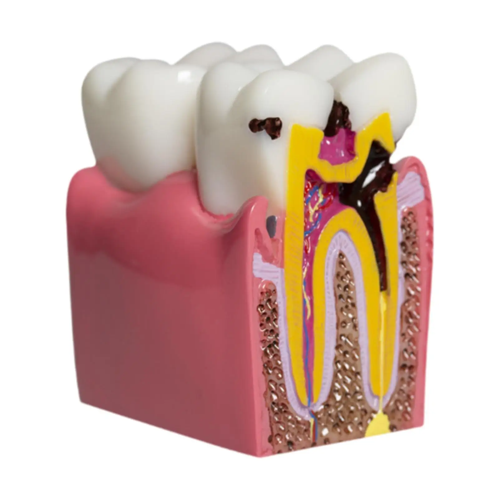 6 Times Caries Tooth Model Resin Caries Structure Detailed Teaching Aid Decay Tooth Comparative Study Model for Students Kids