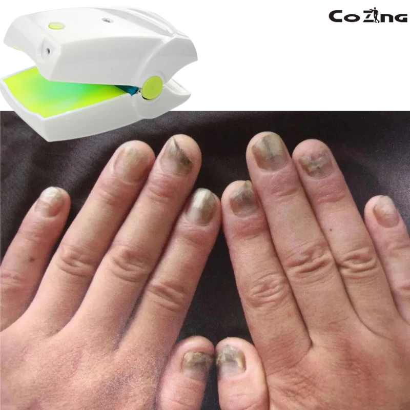 

Upgrade Portable Laser Nail Care Device For Toenail Fingernail Comfort Support Home Beauty Maintenance Safe Rechargeable Tool