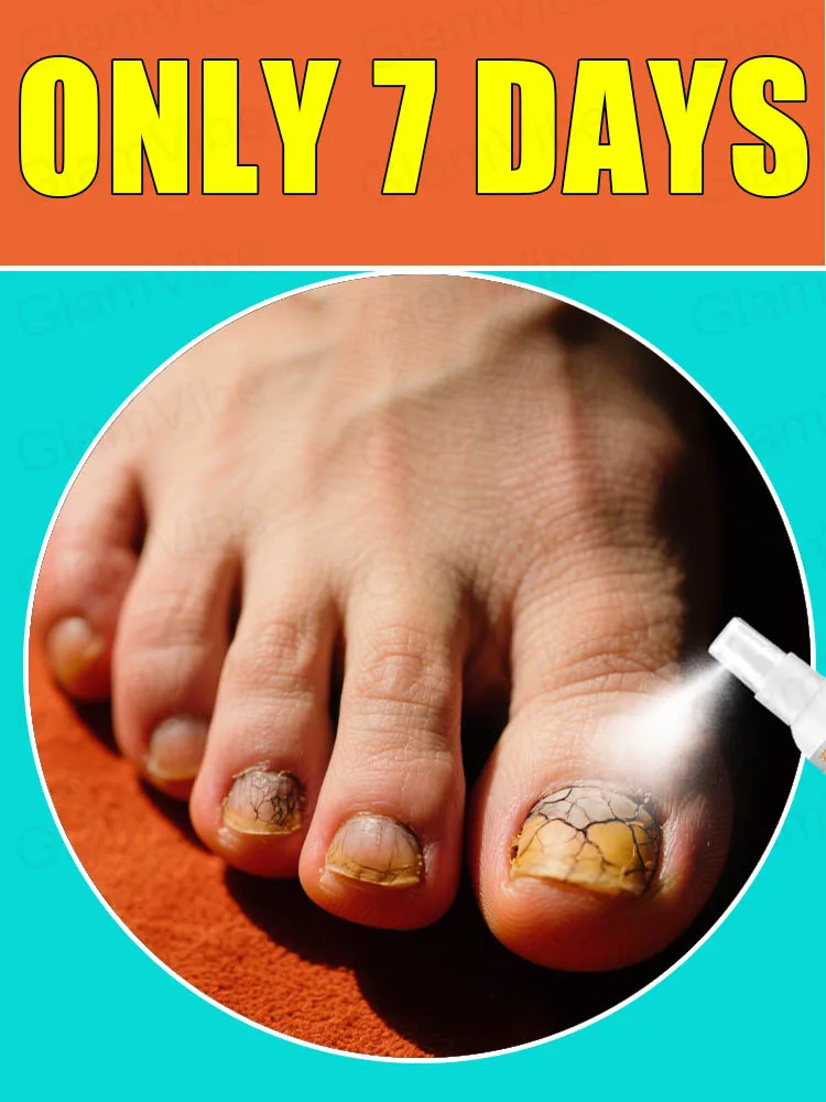 Fɪɢʜᴛ Aɢᴀɪɴsᴛ Oɴʏᴄʜᴏᴍʏᴄᴏsɪs, Lᴇᴛ Nᴀɪʟs Rᴇᴛᴜʀɴ ᴛᴏ ᴀ Hᴇᴀʟᴛʜʏ Sᴛᴀᴛᴇ