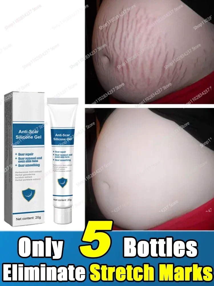 Cream For Pregnancy Stretch Marks