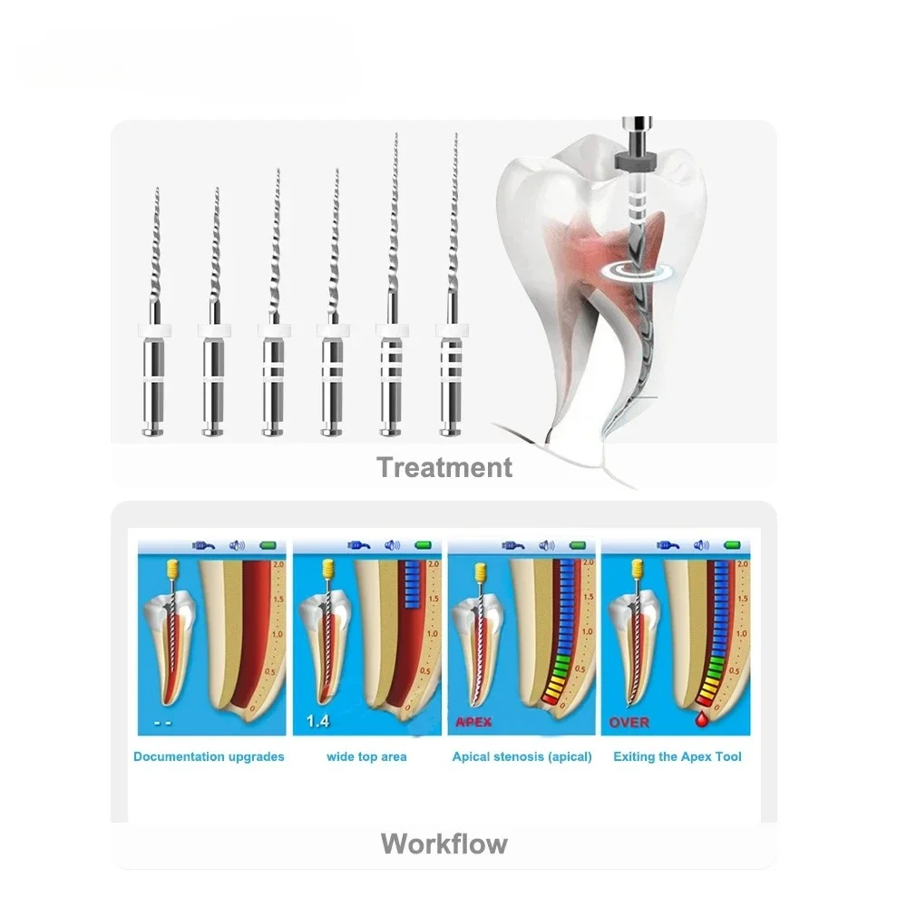 

ELIJAH 6 pcs/Pack Dental Root Canal NiTi File D1-D3 Pulp Therapy Dental Restoration Equipment Root Canal Treatment Dental Tools
