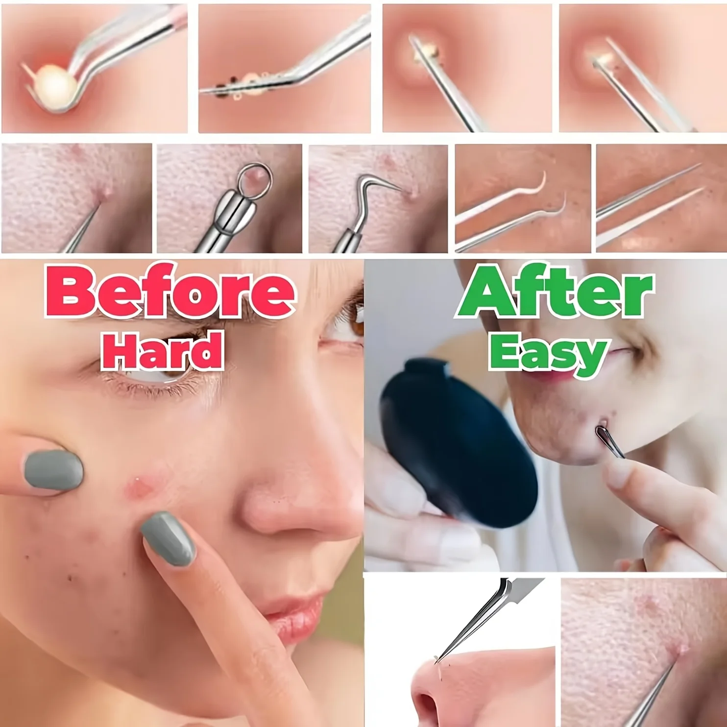 Ensemble d'aiguilles 8 pièces, pince cellulaire, élimination des points noirs, pincettes Ultra-fines, Salon de beauté professionnel, aiguille de haute précision