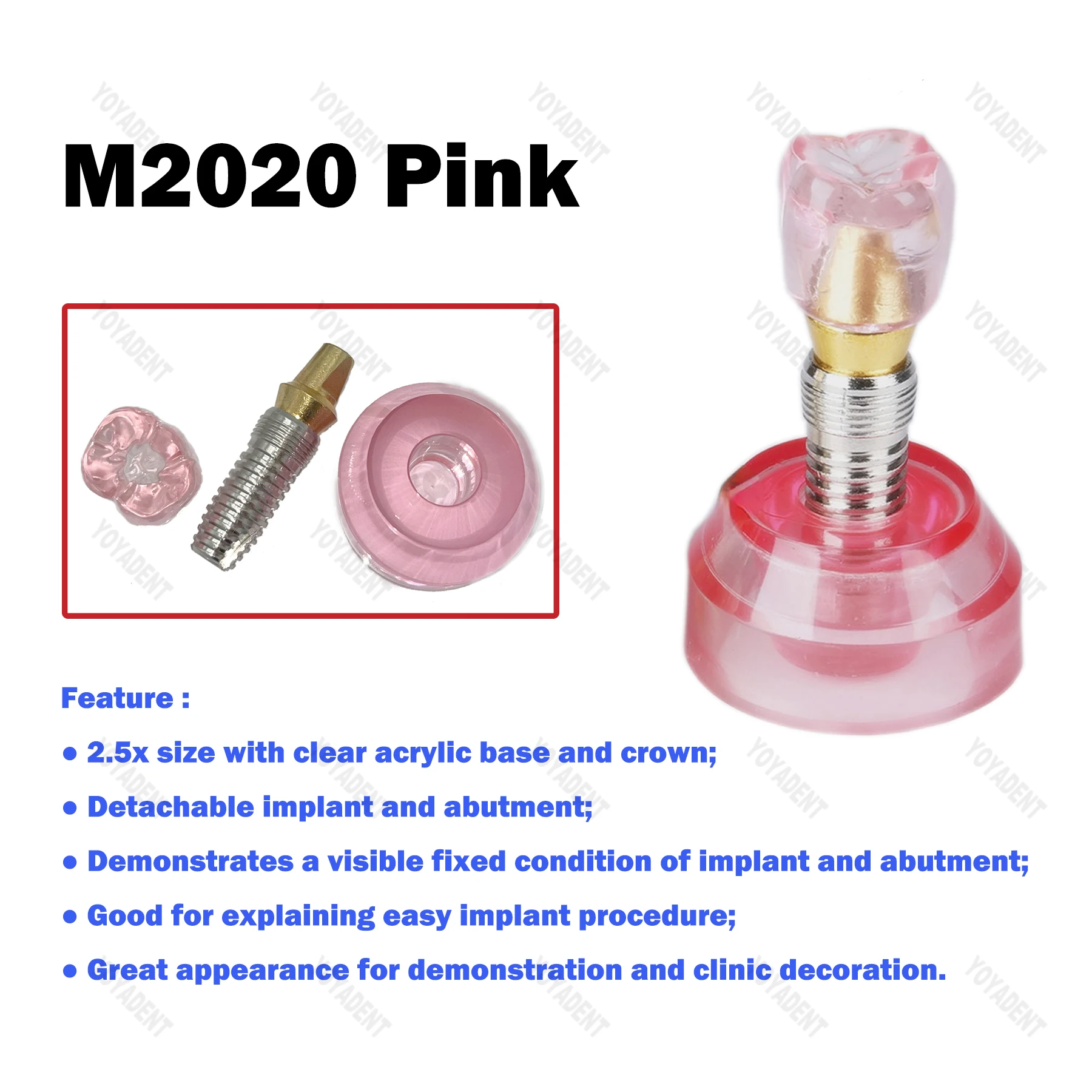 Стоматологическая модель 2,5x размера, модель имплантации зубов, обучающие модели зубов для стоматолога, связь пациента, демонстрационные аксессуары для стоматологии