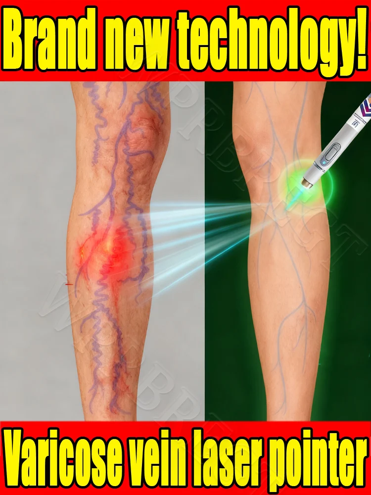 

Varicose vein laser pointer: various venous complications