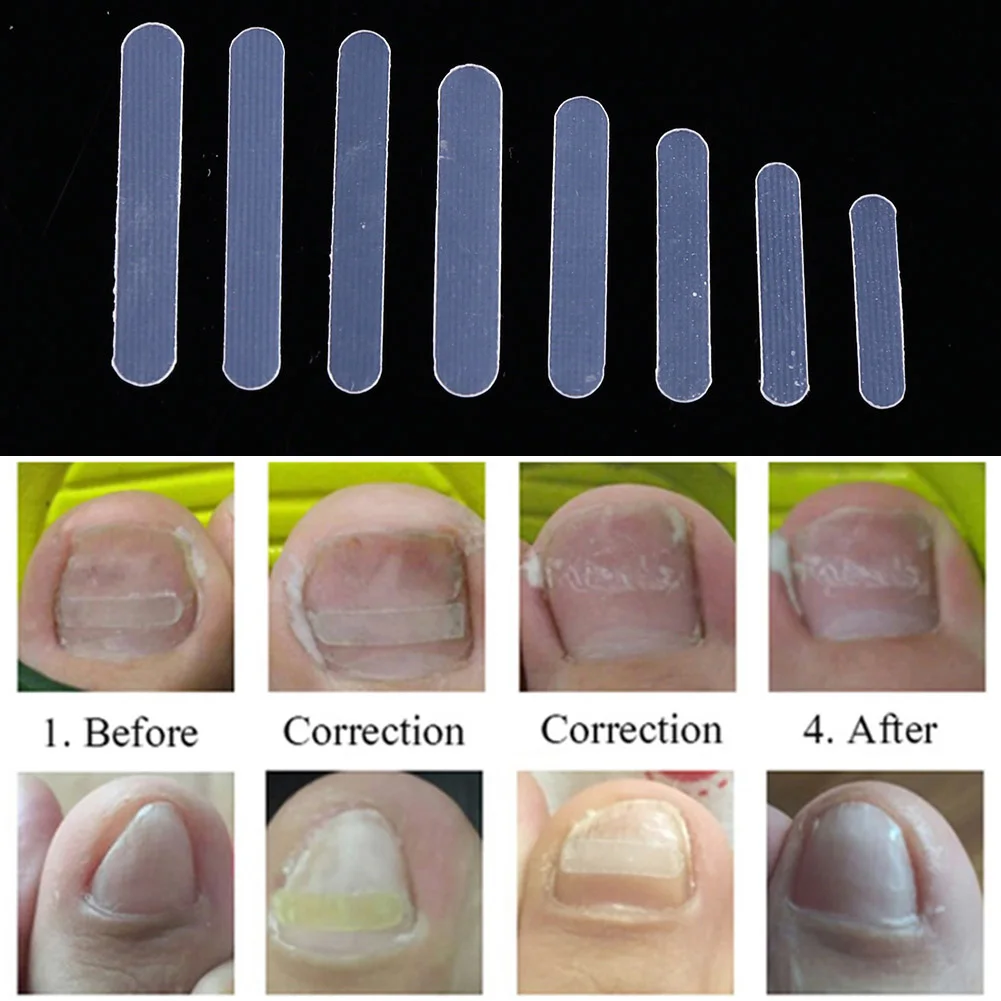 인체공학적 디자인의 편안한 내성 발가락 손톱 교정 스티커, 패치 교정기 파일, 탄성 패치, 100 개