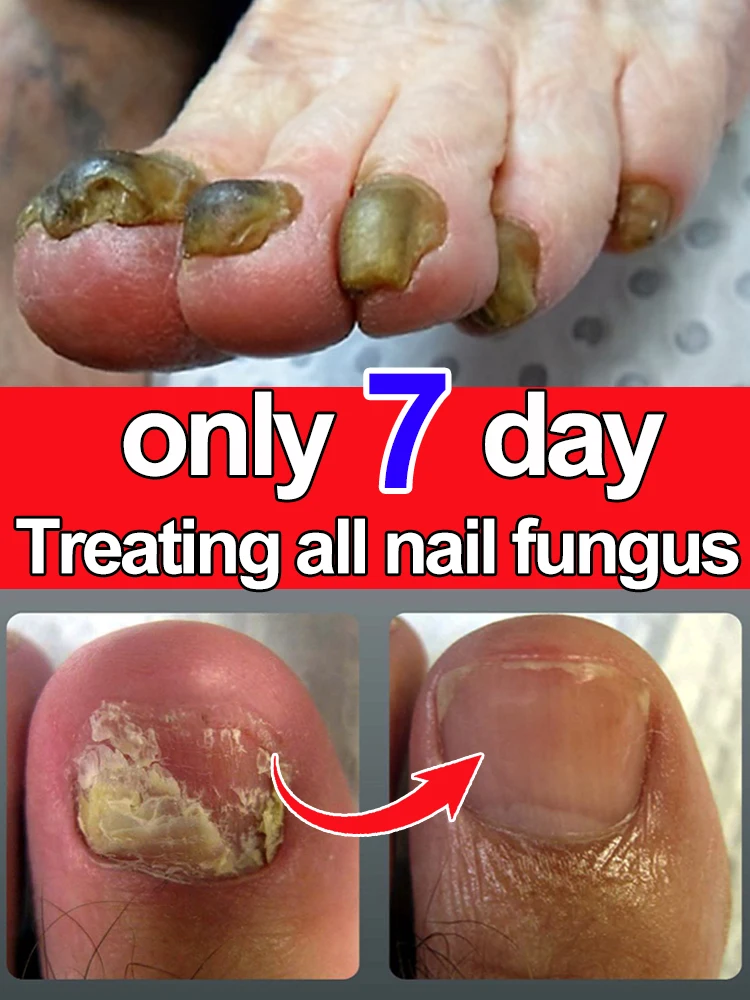 Nail fungus treatment essential oil, repair onychomycosis in 7 days