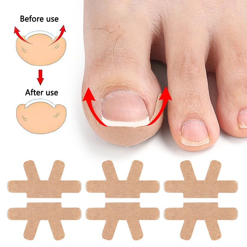 2/4pair Nail Repair Patch Toenail Fungus Patch Sticky Nail Ingrown Correction Sticker Toenail Care Paronychia Nail Patch