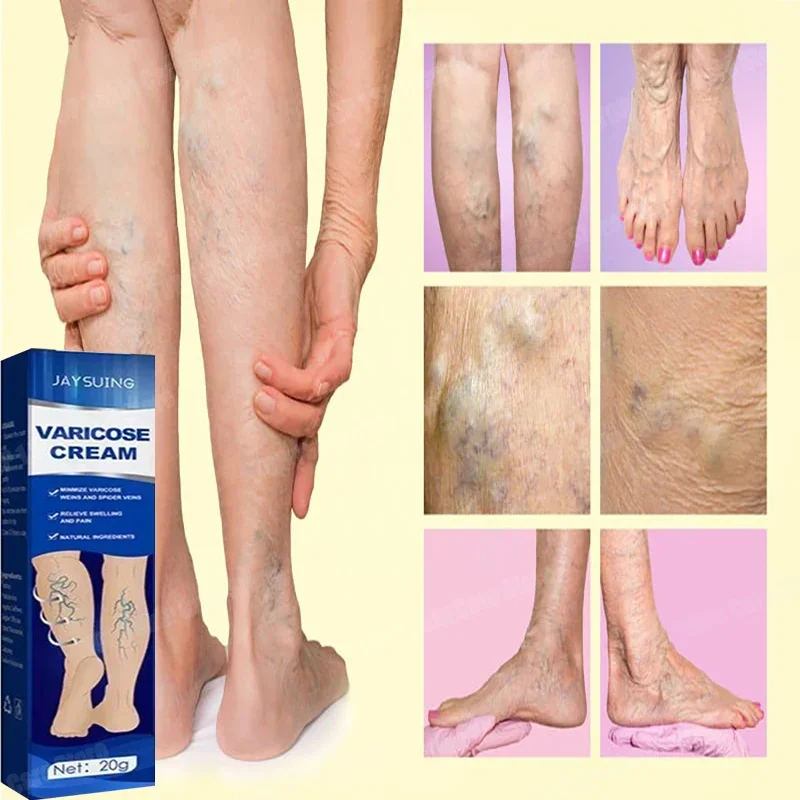 Leg varicose vein cream - improves blood circulation, reduces spider veins and severe symptoms