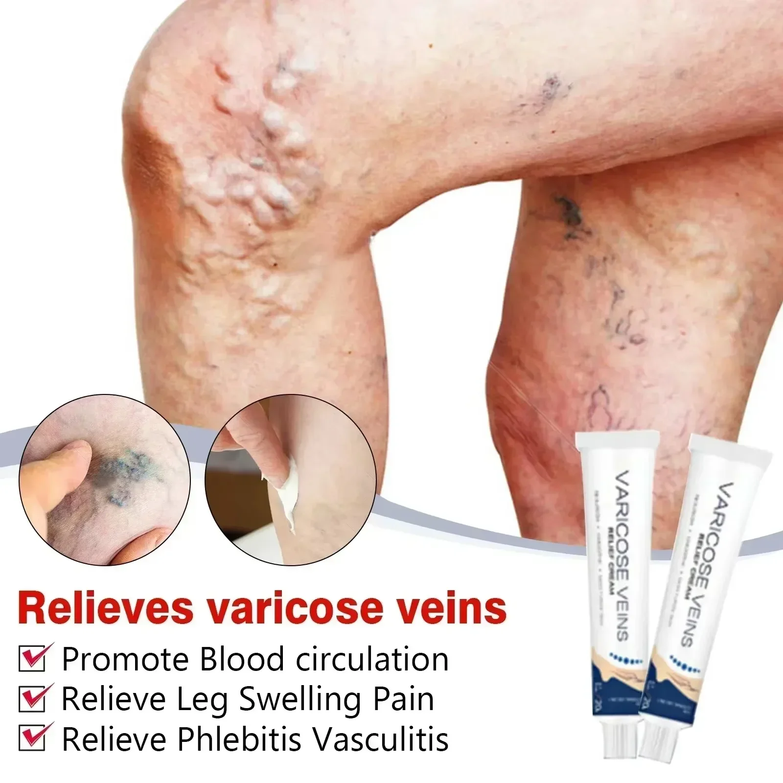 ¦¦¦¦¦¦Varicose Veins Treatment Cream Remove Red Blood Streaks Varicocele Vasculitis Phlebitis Strengthen Capillary Health