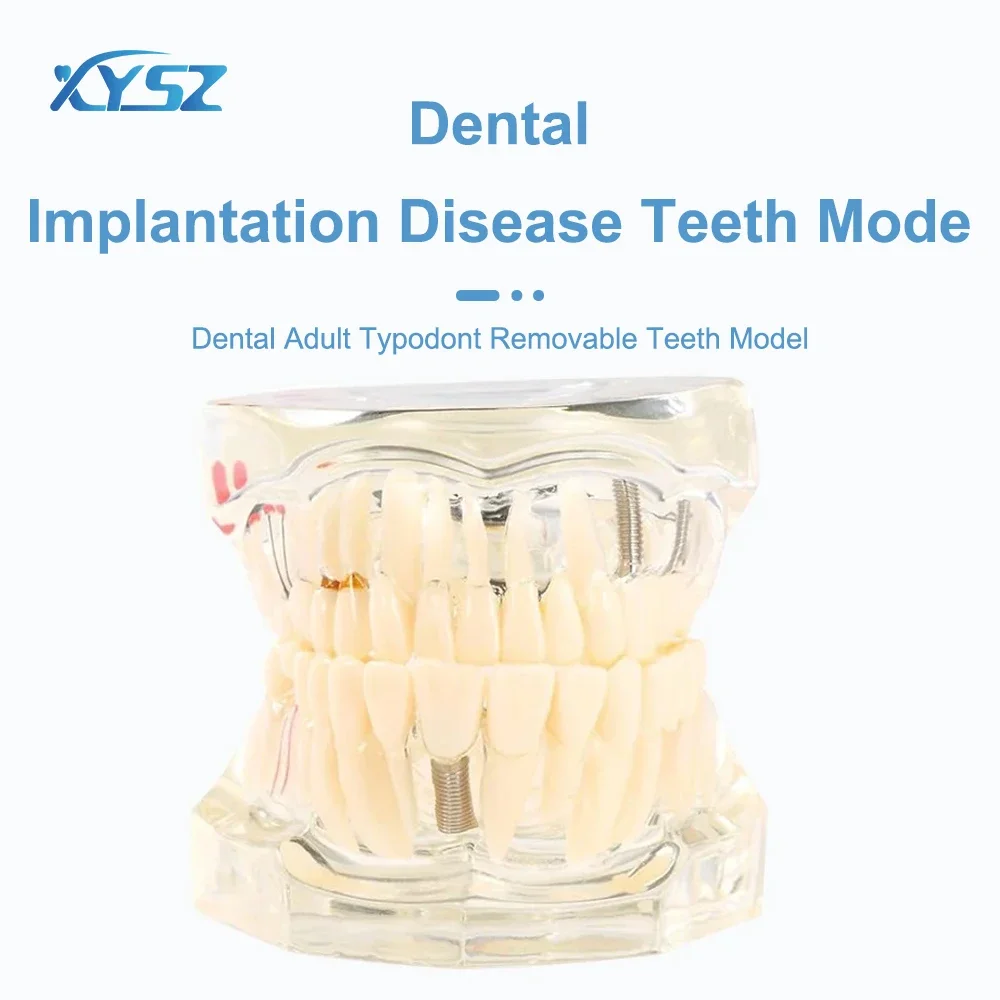 Denspay Dental Implantation Disease Teeth Mode with Restoration Bridge Tooth  Dentist Training and Teaching Model