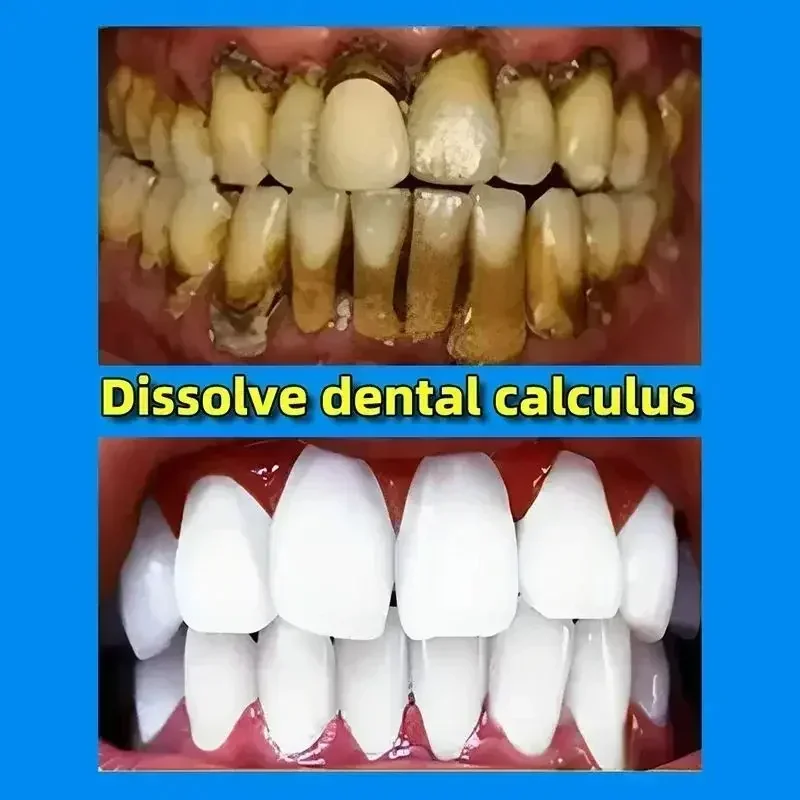 Eliminador de cálculo Dental, eliminación de blanqueamiento, mal aliento, pasta de dientes, brillo, previene la periodontitis, cuidado de limpieza Dental