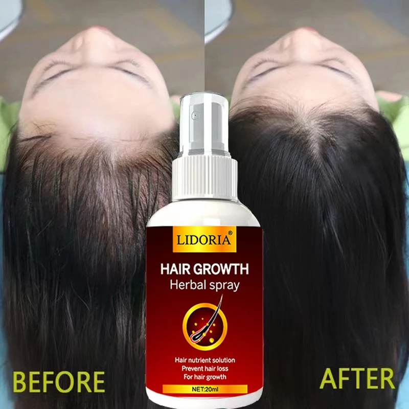 

Promote Longer Thick Hair Growth Serum Save Alopecia Hair Treatment Ginseng Spray Safe and Effective Stimulating Hair Follicles