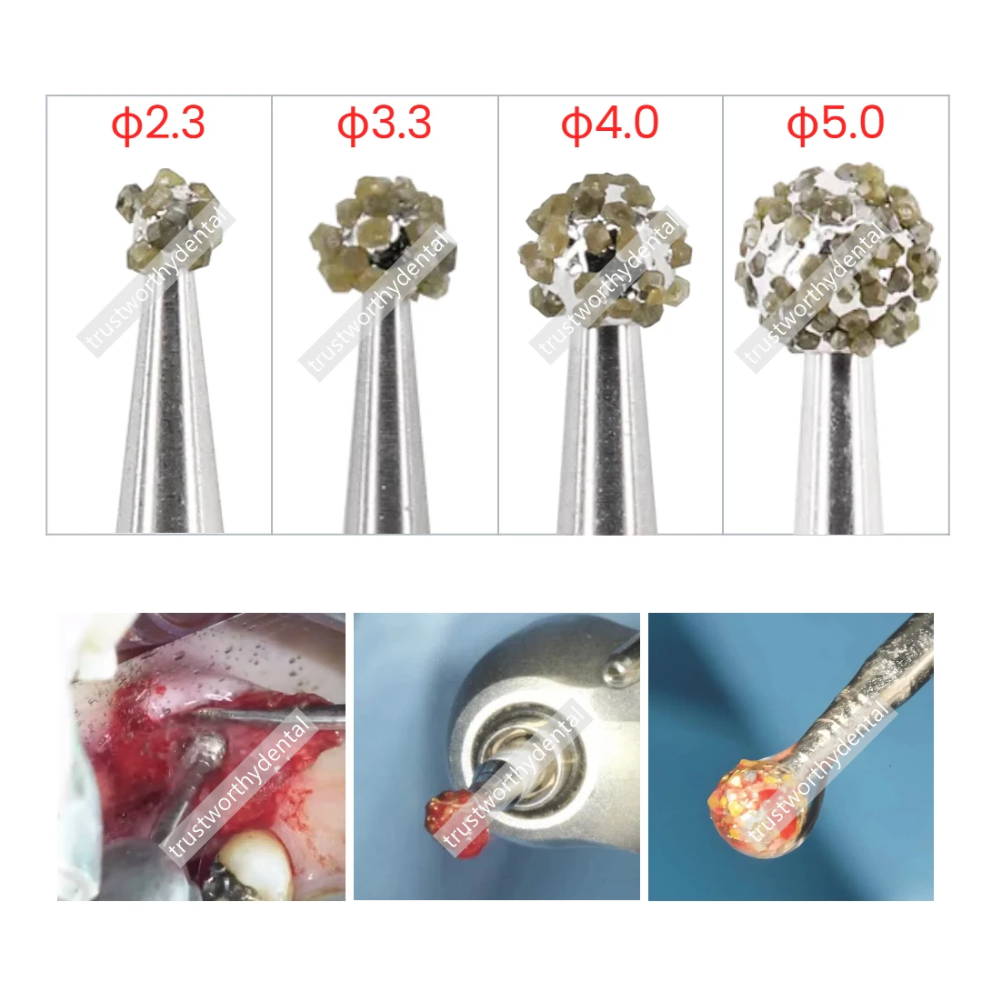 Dental Degranulation Burs Kit Osseous Debridement Soft Tissue Removal From Socket Diamond Ball Burs Φ2.2 Φ3.3 Φ4.0 Φ5.0 - Image 2