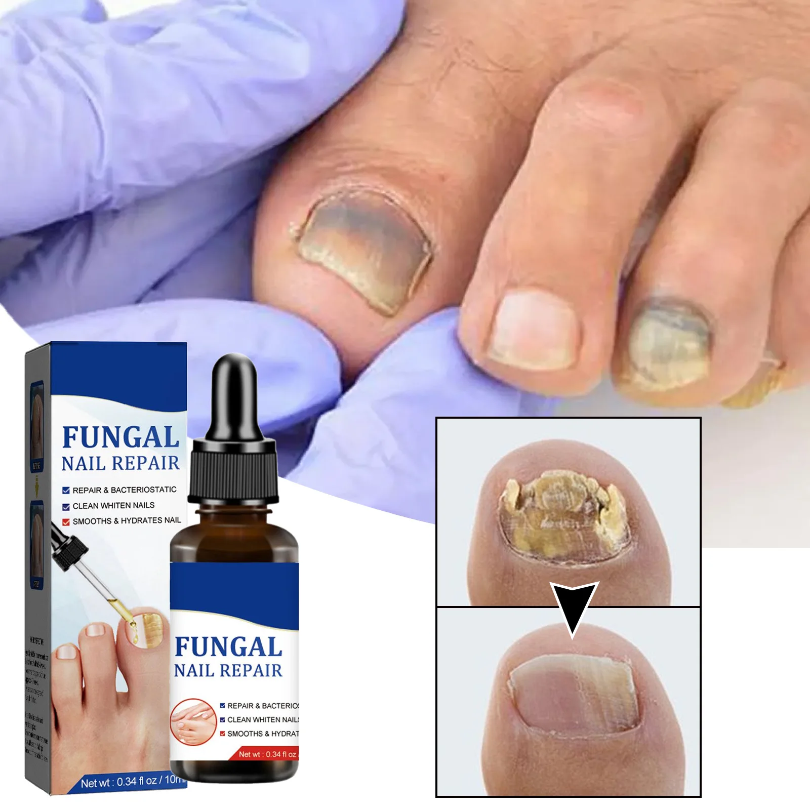 Nail Fungals Renewal Nail Repair Liquid for Discolored Thickened Crumbled Nails Nail Fungals for Discolored Broken Cracked BS85S