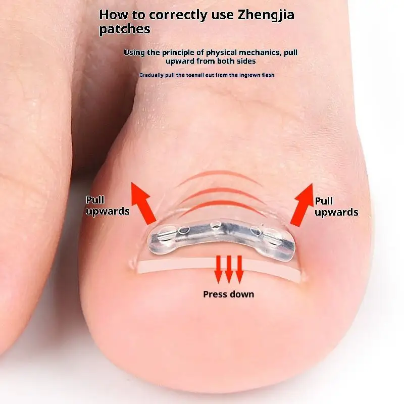 

Ingrown Toenail Corrector Tools Pedicure Recover Embed Toe Nail Treatment Professional Ingrown Toenail Straightening Clip Brace