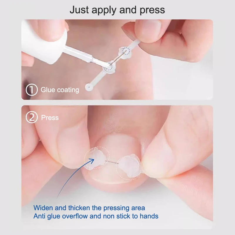 نام استقامة كليب هدفين باديكير أداة تو مسمار العلاج رقعة مرنة ملصق نام أظافر تصحيح أداة