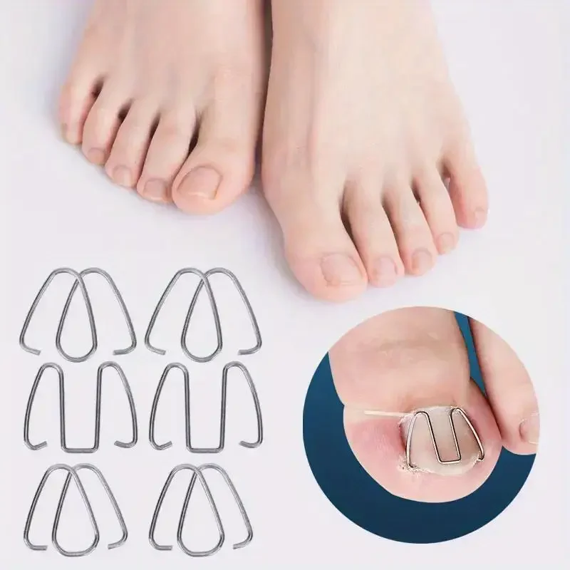 ชุดเครื่องมือแก้ไขเล็บข้อเท้าเกิดจากเล็บงอกขึ้น 6 ชิ้น พร้อมที่รัดเล็บ/ยางรัดสำหรับยืดเล็บ รักษาโรคเล็บข้อเท้าอักเสบ และทำเล็บเท้า