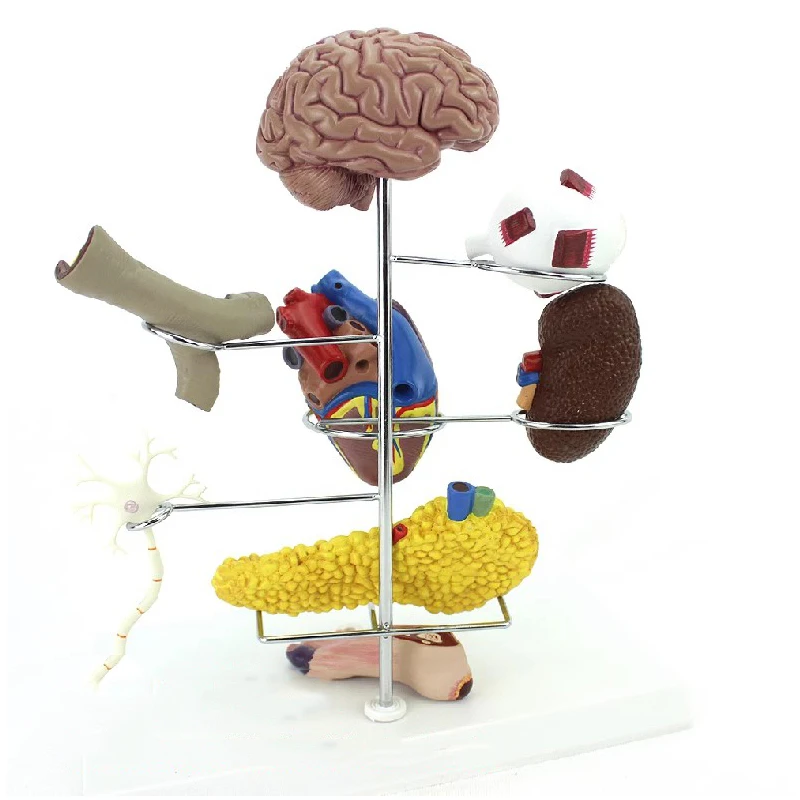 Modelo de órgano humano para la Diabetes, modelo anatómico desmontable, suministros de anatomía médica, herramienta educativa de enseñanza