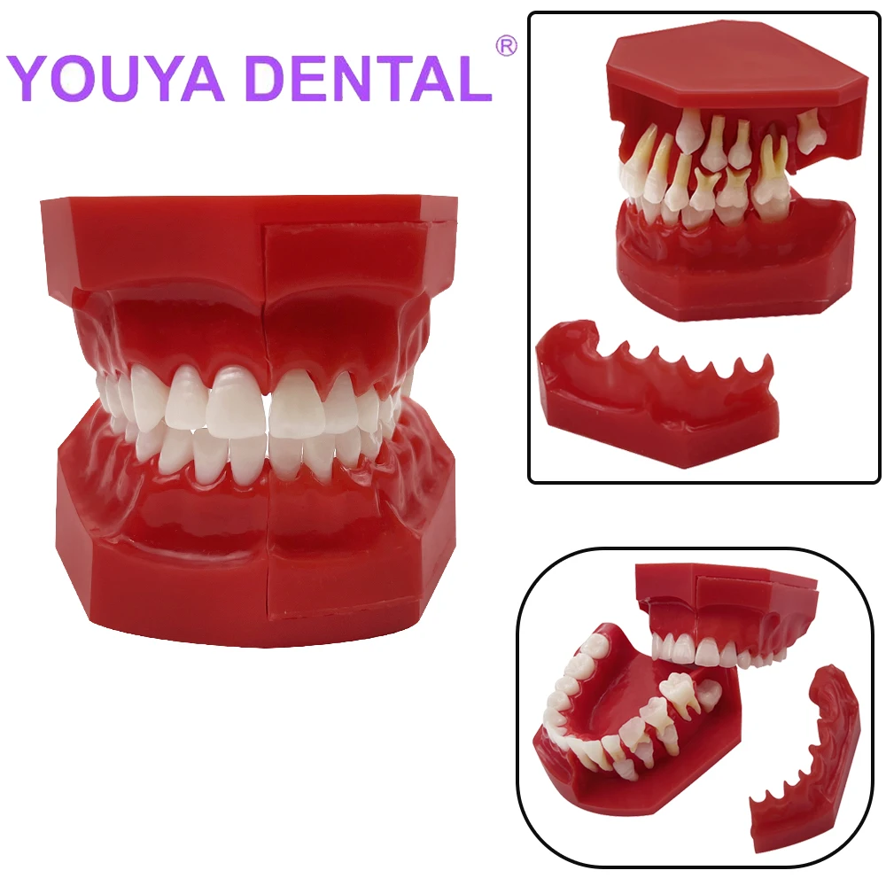 Dental Children 's Deciduous Teeth Replacement Model Milk Permanent Teeth Alternately Display Typodont For Oral Communication