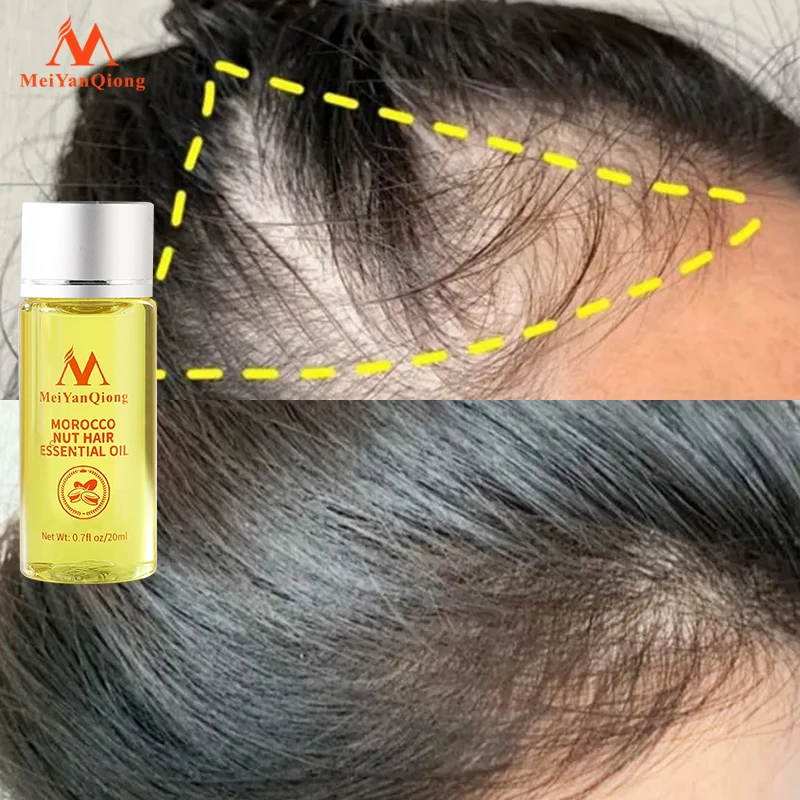 Fast Hair Growth Essence Anti Hair Loss Products Essential Oil Liquid Treatment Preventing Hair Loss Hair Care powerful tonic