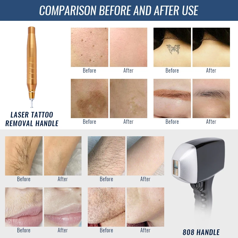 2000W 808 Laser Diode Laser Picosecond Tattoo Removal Hair Removal Machine 3 Wavelength 755nm 808nm 1064 NM diode Laser