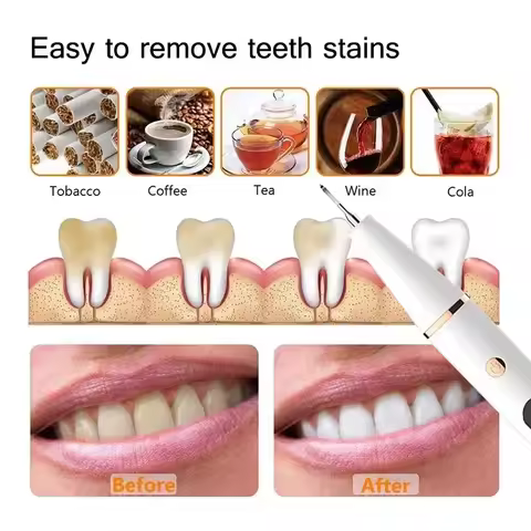 Electric Sonic Dental Calculus Scaler Oral Teeth Tartar Remover Plaque Stains Cleaner Removal Teeth Whitening Portable