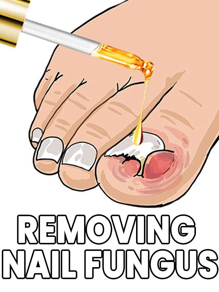 منتج الأظافر الأكثر مبيعًا يزيل الفطريات بشكل فعال