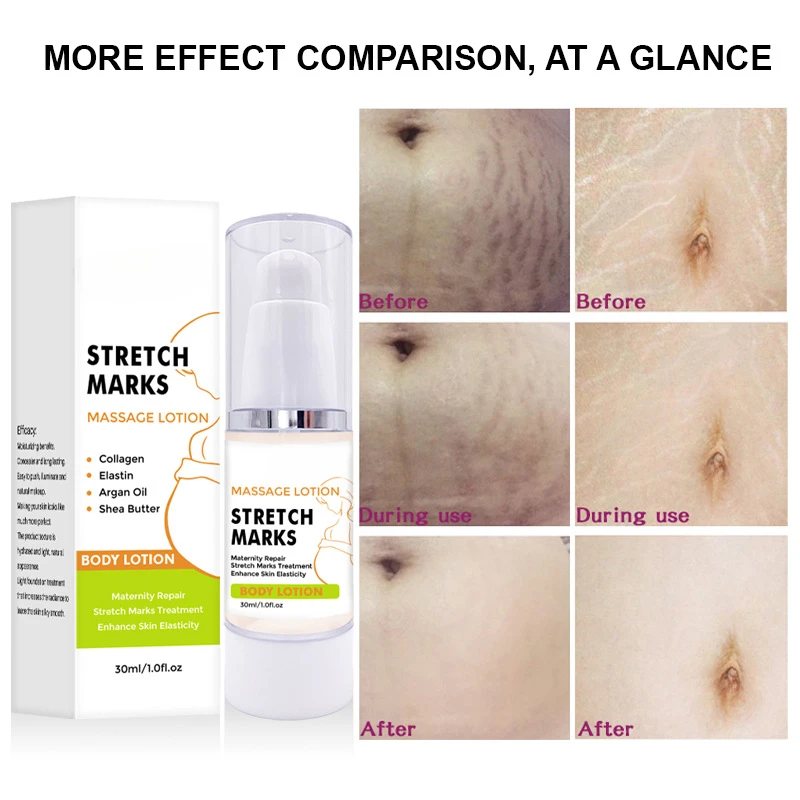 

Remove Pregnancy Scars Acne Cream Stretch Marks Treatment Maternity Repair Scar Slack Line Abdomen Stretch Marks Cream