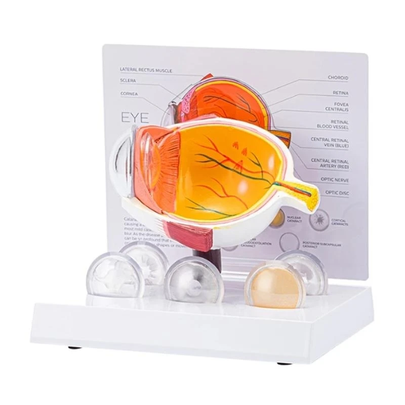 62KA نموذج تشريح مقلة العين المرضية الواقعية للتدريس، واستبحام الاستخدام التعليمي والعرض السريري