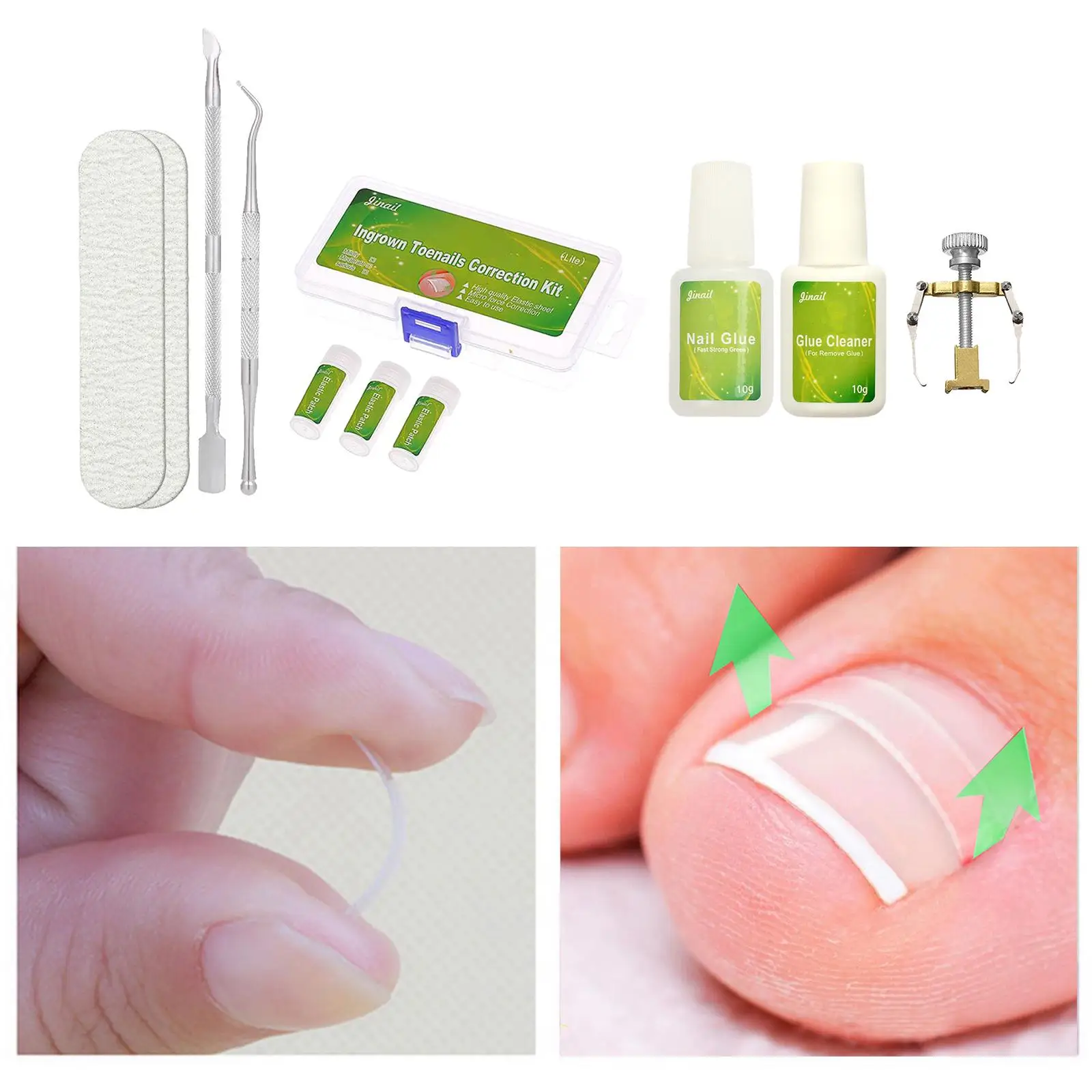 Aufkleber zur Nagelkorrektur, Aufkleber zur Korrektur eingewachsener Zehennägel, Pediküre