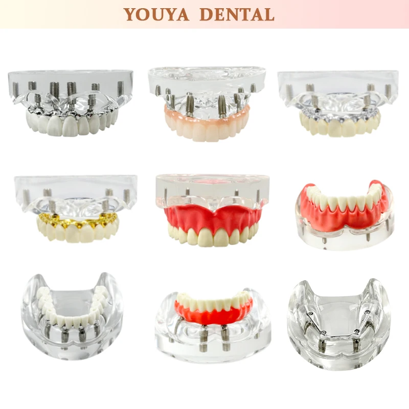 

Dental Removable Upper and Lower Mandibular Covered Denture Model Dental Research Experimental Teaching Training Dental Model
