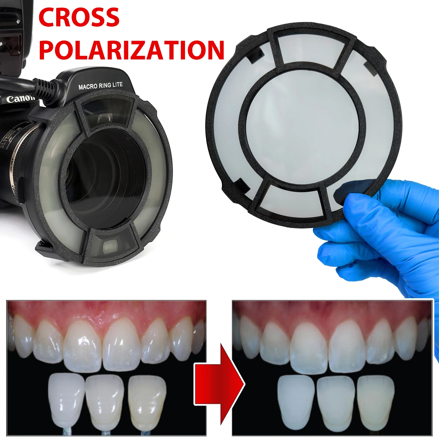 MEIKE Flash With Cross Polarizing Lens Filter For Dental Photography - No Glare, No Relfection Oral Photography For Dentist